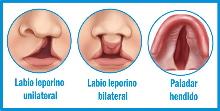 10 Biberones Para Bebés Con Labio Leporino Y Paladar Hendido 8210