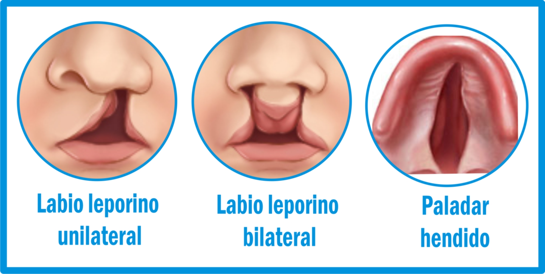 10 Biberones Para Bebés Con Labio Leporino Y Paladar Hendido 3014