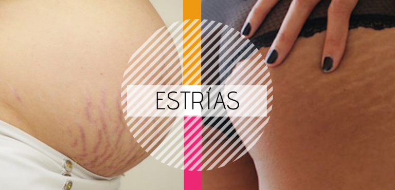 ¿Cómo desaparecer las estrías? Trucos de una mamá