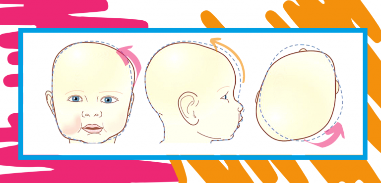¿Qué es la Plagiocefalia?